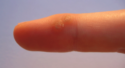 Unusual Causes of Warts You Might Not Know