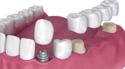 The Benefits of High-Quality Dental Bridges and Crowns