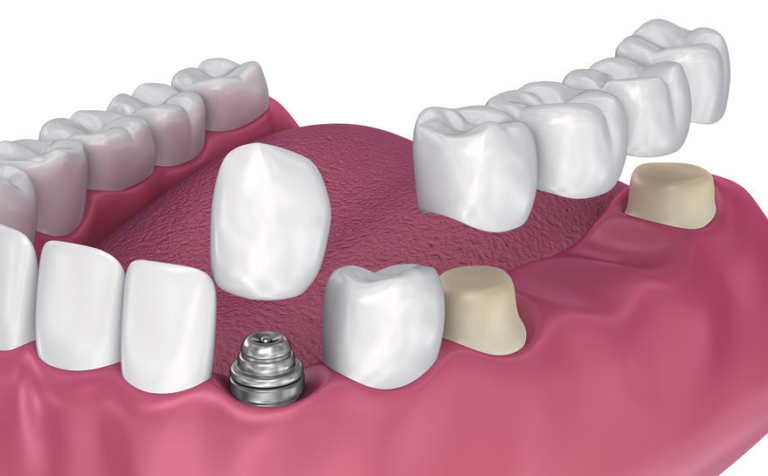 The Benefits of High-Quality Dental Bridges and Crowns