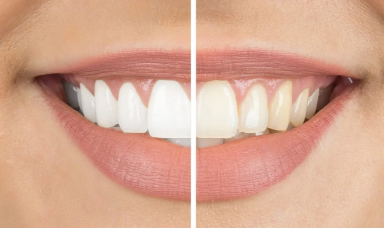 How to Achieve a Brighter Smile at Home